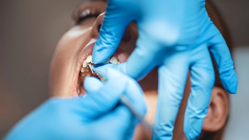 The real risk: unnecessary tooth reduction